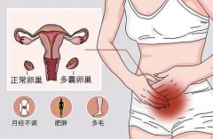 台湾合法供卵中介：治疗多囊卵巢综合征
